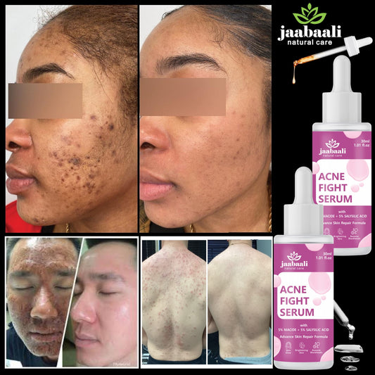 Jaabaali Natural Care Acne Fight Serum with 5% Niacide acid and 5% Salysilic acid for remove pimples and dark spot. Suitable for all type of skin. 60ml (Pack Of 02)